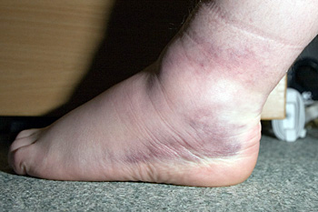 Ankle 2